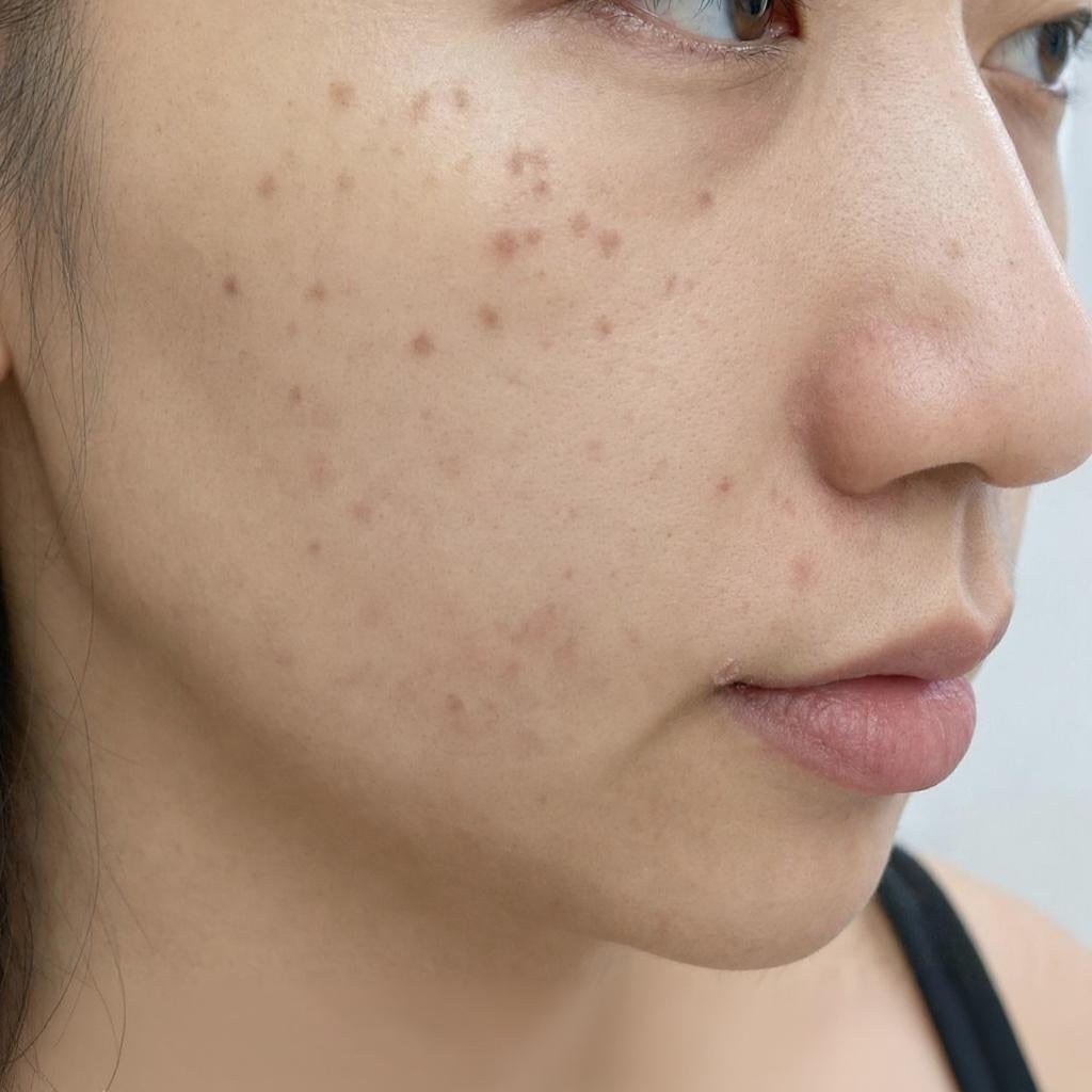 激光去斑會結焦嗎？點斑、全臉 Toning 與修復期有甚麼分別？